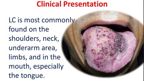 10 MIN REVISION: Lymphangioma Circumscriptum - YouTube