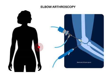 150 Arthroscopic Surgery Stock Illustrations Royalty Free Vector