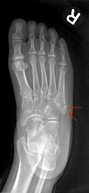 5th Metatarsal Base Fracture - Foot & Ankle - Medbullets Step 1