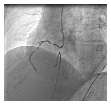 A 3 0 18 Mm Drug Eluting Stent Deployment B After Stent Deployment