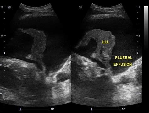 Bilateral Pleural Effusion Ultrasound Lung Ultrasound Pleural