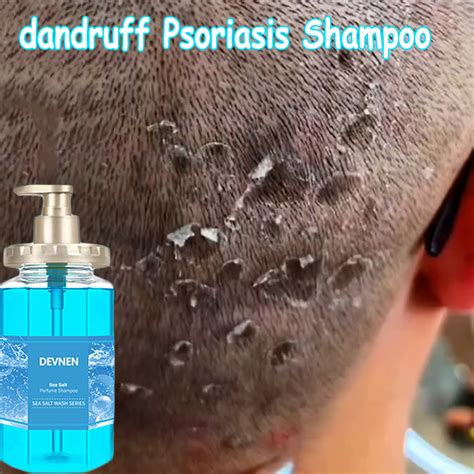 Psoriasis Shampoo Kelemumur Ubat Kepala Scalp Dandruff Kutu Sea Salt