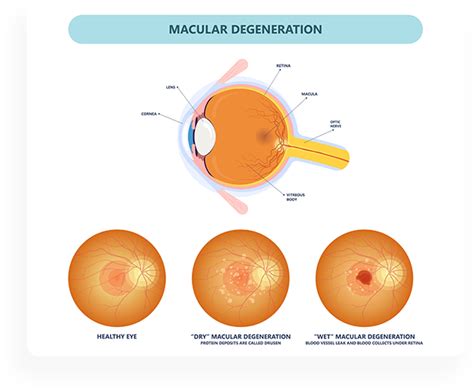 Dry Vs Wet Macular Degeneration