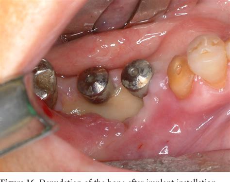 Figure 16 From Osteonecrosis Of The Jaw After Implant Surgery In