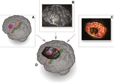 Intraoperative Optical Imaging Of Metabolic Changes After Direct