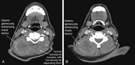 Imaging Soft Tissues Of The Neck Radiology Key