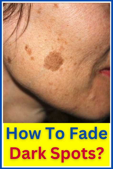 Lighten Age Spots Naturally? | Dark spots on skin, Age spots on face ...