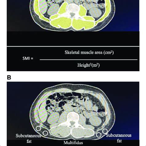 Measurement Of The Skeletal Muscle Mass Index Smi And Intramuscular