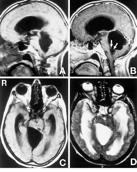 A B Preoperative Sagittal T 1 Weighted Magnetic Resonance MR Images