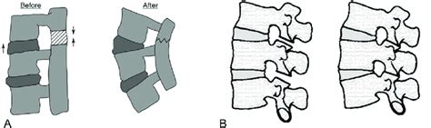 A Smith Petersen Osteotomy Anterior Opening And Closure Of The