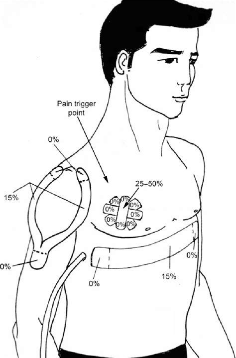 Schematic Illustration Of Kinesiology Taping KT Sites Showing A