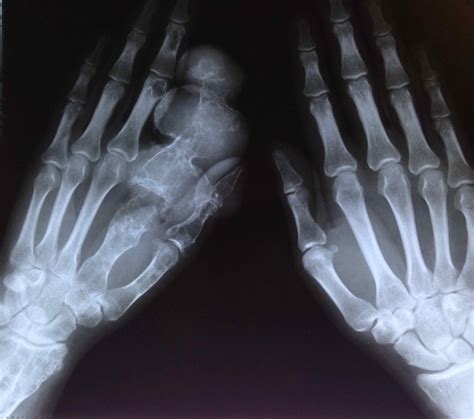 Chondrosarcoma Cases And Medical Insights Figure