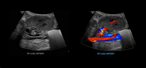 Renal Transplant Duplex Protocol – Sonographic Tendencies