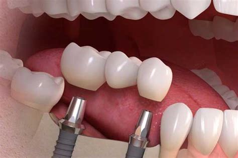 Osteoporosis Y Diabetes Amenazas Para Los Implantes Dentales