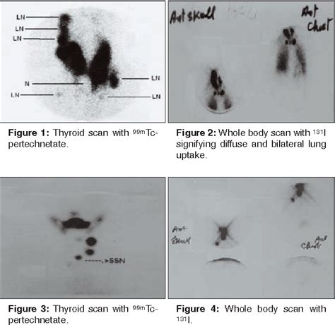 Figure 1 From Extrathyroidal Uptake From Thyroid Carcinoma On 99mtc