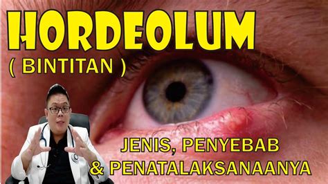 HORDEOLUM BINTITAN JENIS PENYEBAB DAN PENATALAKSANAANYA