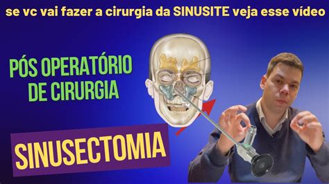 PÓS OPERATÓRIO DA CIRURGIA DE SINUSITE SINUSECTOMIA YouTube