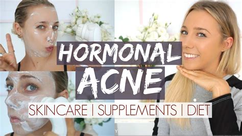 Hormonal Acne Update Skincare Supplements Diet Youtube