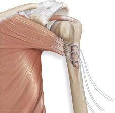 pec repair loiy alkhatib md