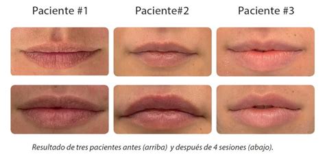 Nuevo Protocolo Labios Elektra By Clearlift Alma Médica