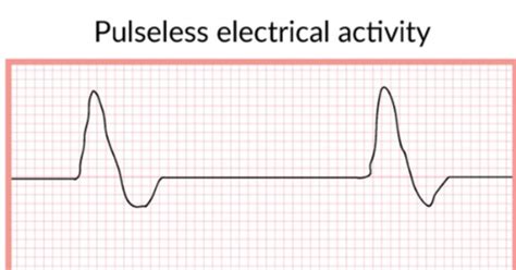 EKG Diagnostics 2 Arrhythmias Flashcards Quizlet