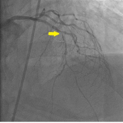 Ekg At Presentation Showing St Elevations With Q Wave In Leads 2 3 Avf Download Scientific