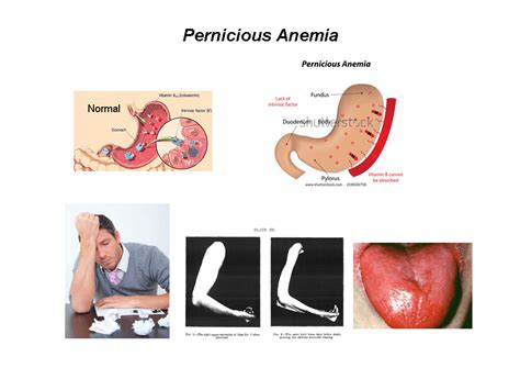 Apprendre Conna Tre L An Mie Pernicieuse Causes Sympt Mes Et