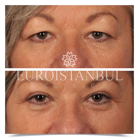 Eyelid Surgery Blepharoplasty All Inclusive Package 2 500