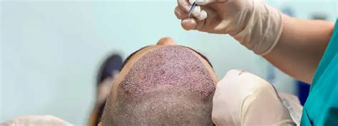 How To Clean And Remove Scab After Hair Transplant Surgery Hair