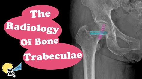 The Radiology Of Bone Trabeculae YouTube