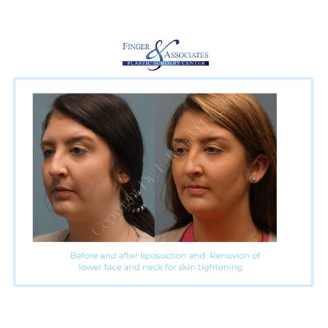 Renuvion For Skin Tightening With Minimal Downtime