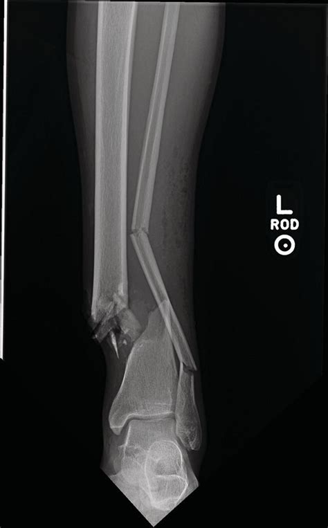 Orthopedic and Hand Trauma | Anesthesia Key