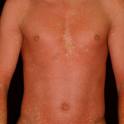 Amoxicillin Rash In A Patient With Infectious Mononucleosis Patient