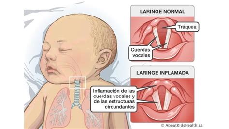 Laringotraqueitis Pediatria Tos Metalica Tos Perruna PPT