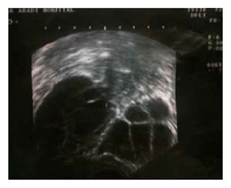 Ultrasound Image Shows Bilateral Ovarian Multilocular Cysts Extending