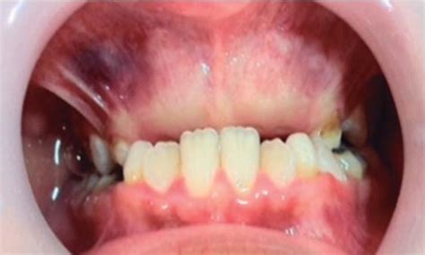 Delayed Eruption Of Central And Lateral Incisors Tooth Because Of Odontoma Download Scientific