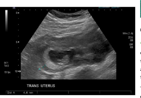 Figure 3 From Surgical Expression Of An Un Ruptured 12 Week