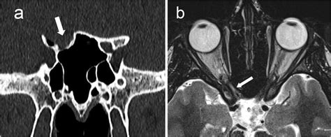 a Coronal postoperative CT scan image showing a wide opening of the ...