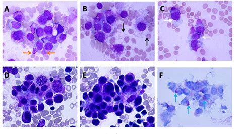 Figure 1 From Mast Cell Leukemia In A Patient With Teratoma Semantic