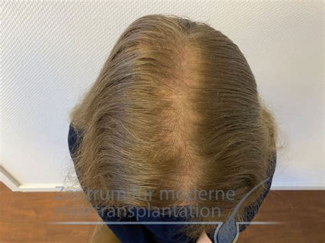 Vitamine Haare 5 Wichtige Vitamine für Haarausfall Wachstum