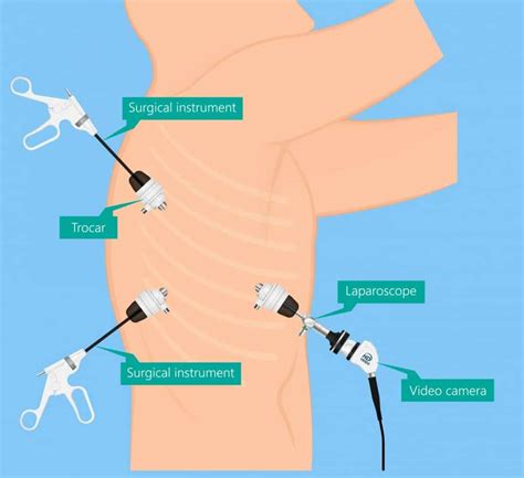 Lung Cancer Teachmesurgery