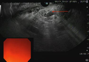 Eus Guided Rendezvous Technique For Pancreas Divisum Videogie