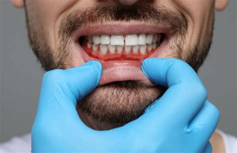 C Mo Prevenir La Recesi N Gingival Consejos Y Tratamientos