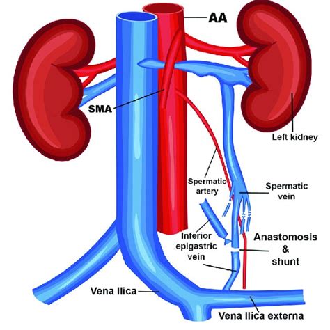 Schematic Diagram Of Spermatic Cord Inferior Epigastric Vein