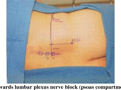 Comparative Study Of Psoas Compartment Block And Sciatic Nerve Block