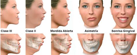 Cirugía Ortognática en Torrejón de Arroz Clínica Dental y Maxilofacial