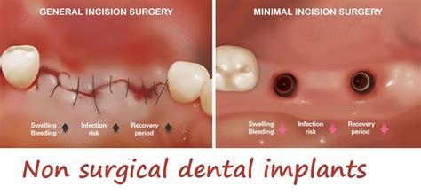 Non Surgical Dental Implants Dental Specialist Clinic