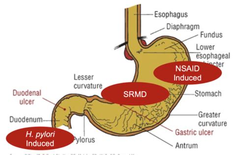 Peptic Ulcer Disease Flashcards Quizlet