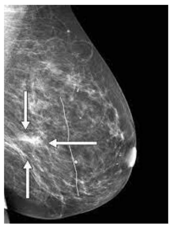 Lab Med Breast Imaging Flashcards Quizlet