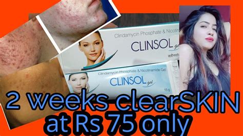 Clinsol Gel Review In Hindi Honest Review Best Treatment From Acne And